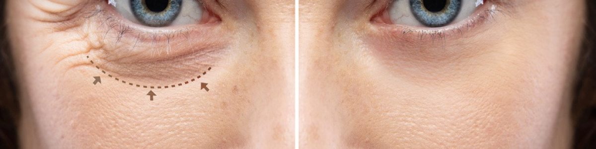 Before and after a rejuvination treatment, wrinkles and crow's feet removal Lines and arrows shows blepharoplasty zone